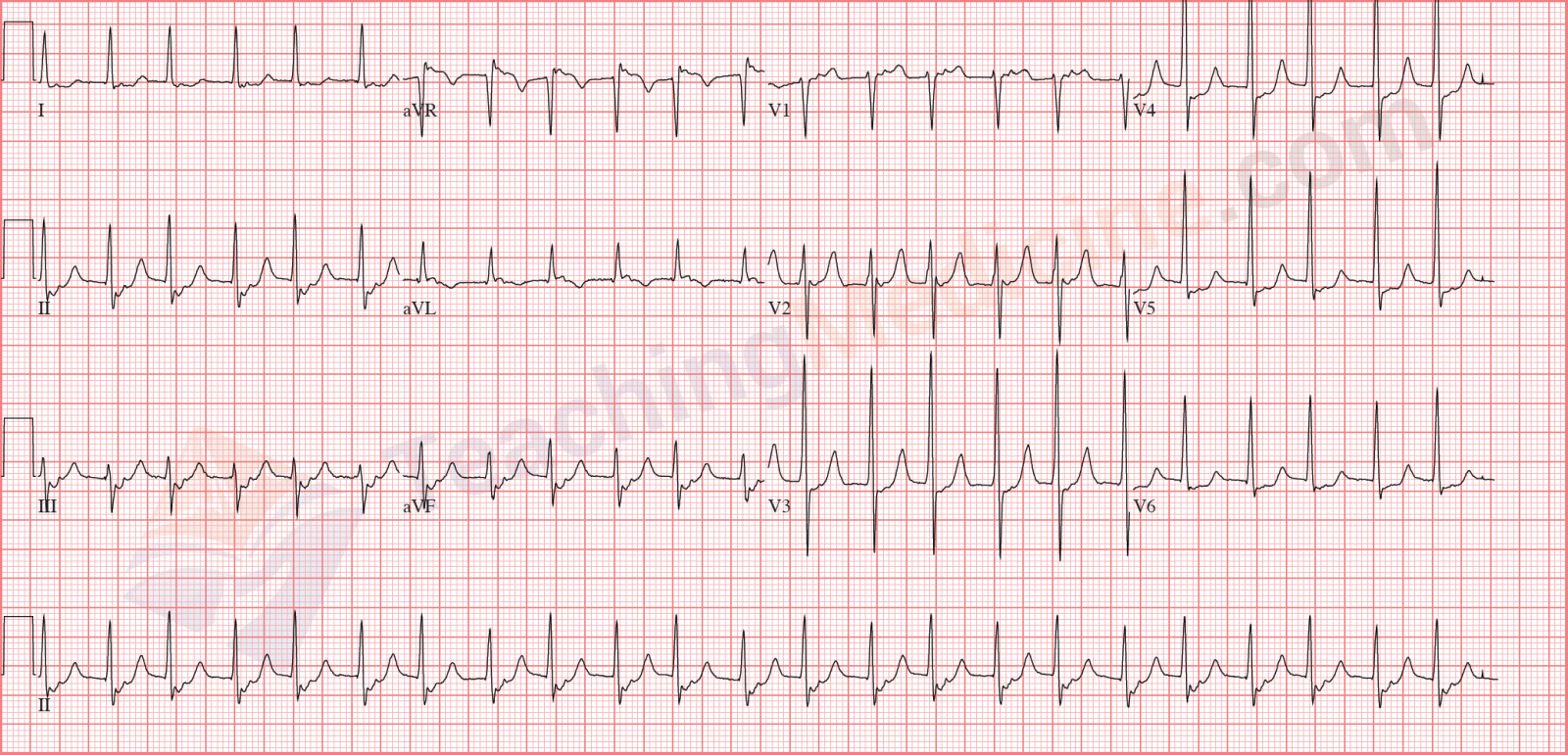 Teaching Medicine Tutorial Rhythm Diagnostic Criteria